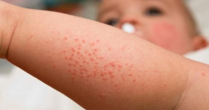 larruazaleko rash parasitoaren infekzioaren sintoma gisa